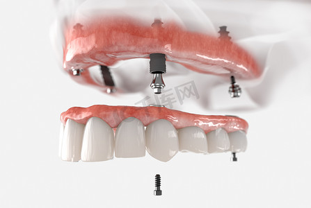 植入物摄影照片_上颌固定修复4个植入物。现实的3D例证.