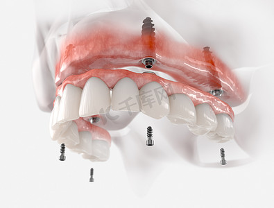 上颌固定修复4个植入物。现实的3D例证.