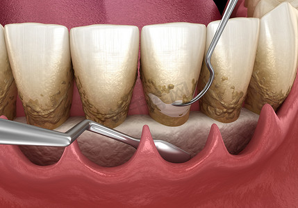 开切：鳞片和根部修整（传统的牙周病治疗） 。医学上准确的人类牙齿治疗三维图像
