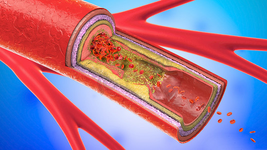 心脑血管卡通摄影照片_3d. 血管或动脉硬化的沉淀和收缩的图示
