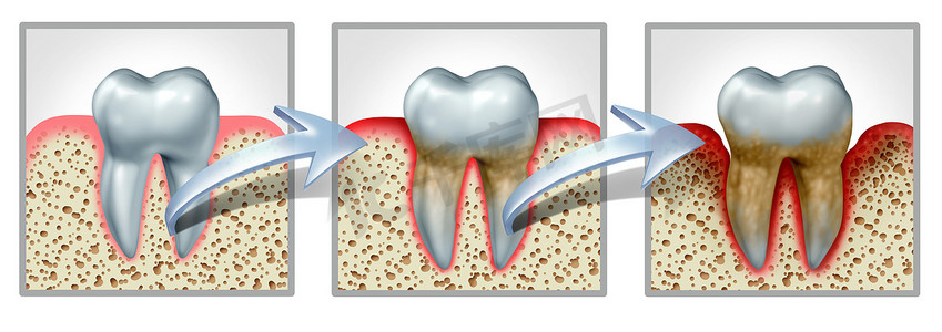动感例子摄影照片_牙齿及牙龈疾病