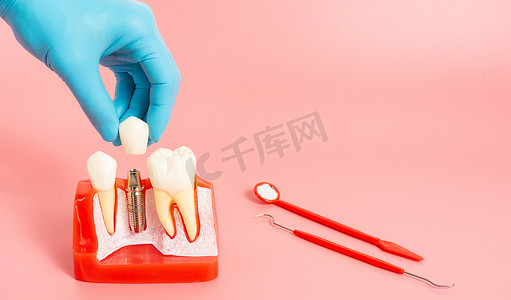 用硅胶制成的假牙植入物的例子表明了假牙植入物的成分。当植入病人的牙龈供病人在开始治疗前理解时.