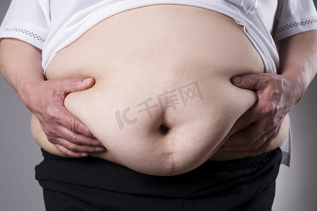 女人身体肥胖，肥胖的女性腹部从腹部手术疤痕关闭