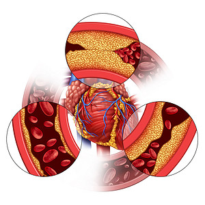 影视元素摄影照片_心脏动脉疾病和冠心病的医学概念，即逐渐形成斑块，导致动脉阻塞和动脉粥样硬化，是具有三维示踪元素的人体解剖学.