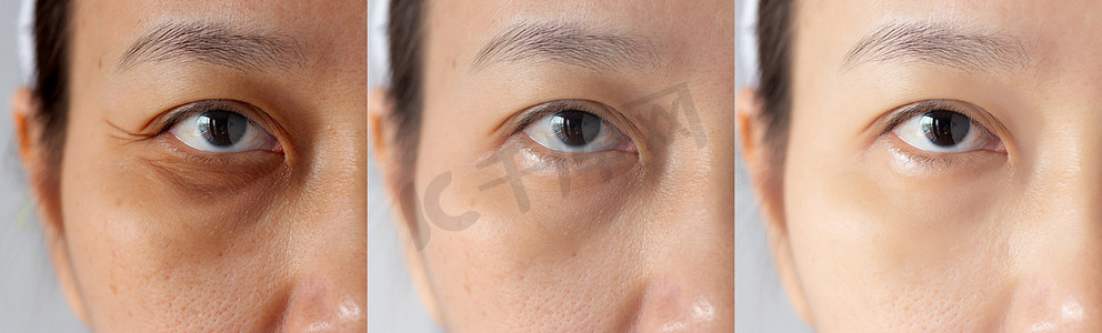 靶向治疗摄影照片_三张图片比较治疗前后的疗效。 眼底有黑眼圈、眼窝肿胀、眼眶周围皱纹等问题，治疗前后可改善皮肤状况