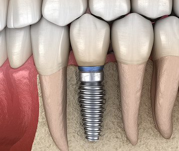 植入物摄影照片_前磨牙修复植入物。医学上准确的人类牙齿和假牙概念三维图像