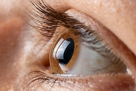 眼角膜，3度。角膜收缩以锥形、视力下降、散光的形式出现。宏观收尾
