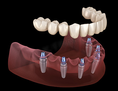 下颌骨假体全部安装在6个由植入物支撑的系统上。医学上准确的人类牙齿和假牙概念三维图像