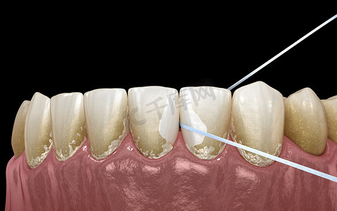 口腔卫生：使用牙线去除牙菌。医学上准确的牙科 3D 插图