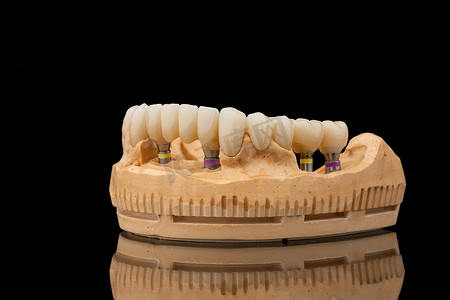 植入物摄影照片_在黑色玻璃背景下的下颌骨假牙的特写侧视图。人造下颚，有镶边和冠冕。植入物的牙齿恢复。牙科学概念照片.