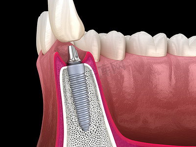 标准基托,假牙植入物和陶瓷冠.医学上准确的牙齿3D图像.