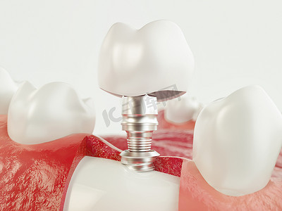 牙人体植入物。牙科的概念。人的牙齿或假牙。3d 渲染
