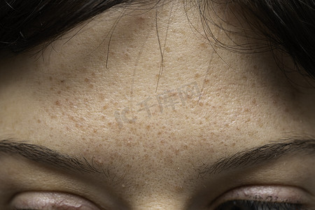 一位皮肤油腻的年轻高加索女孩额头上的特写镜头，导致了斑点、疤痕和伤痕，这在年轻的成年人中很常见.