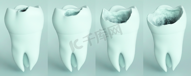 磨牙上的蛀牙阶段--3d 渲染
