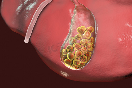 vr显示屏摄影照片_胆结石，插图显示底部视图的肝脏和胆囊结石