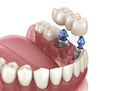 植入物摄影照片_由植入物支撑的牙桥.医学上准确的人类牙齿和假牙概念三维图像