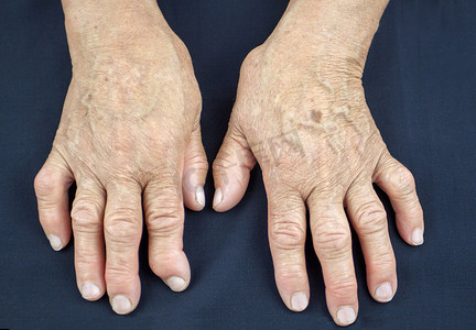 类风湿关节炎从变形的女人的手