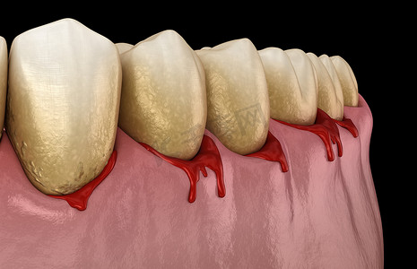 404状态页摄影照片_牙龈出血或牙周炎-牙龈和骨支撑的病理状态.牙科3D图解