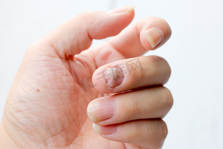 真菌感染对指甲的手，手指与甲真菌病。-软焦点