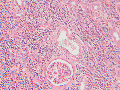 肾功能衰竭组织学显微照片染色显示肾组织间质性肾炎