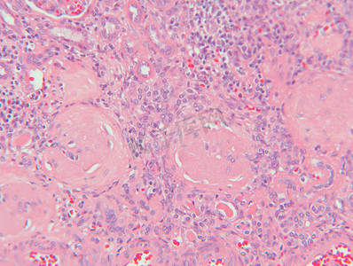 肾功能衰竭组织学显微照片染色显示肾组织间质性肾炎