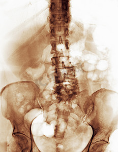 图像视频摄影照片_伴有退行性关节炎改变的脊柱光片