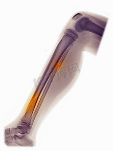 小腿线片显示腓骨和胫骨骨折