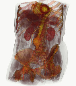 扫描显示腹主动脉瘤