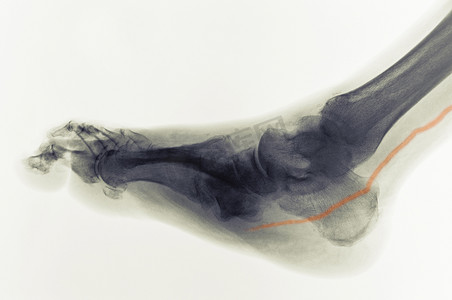 人体艺丝袜术摄影照片_糖尿病足线示动脉钙化