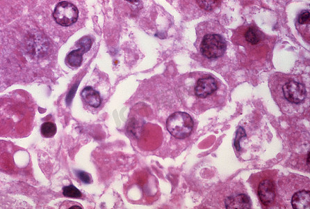 埃博拉病毒感染肝细胞的光镜观察