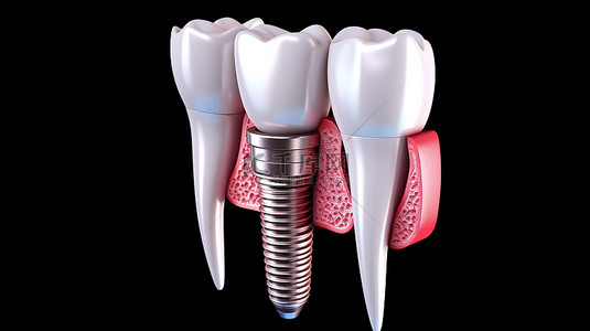 种植牙步骤背景图片_通过 3D 医学渲染图说明种植牙治疗的精确步骤