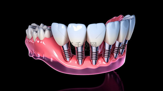 准确判断背景图片_医学上准确的牙种植手术 3D 插图