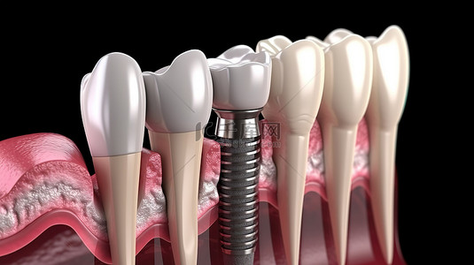 3D 渲染植入物部分与隔离牙龈的特写视图