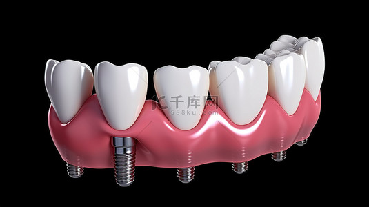 手术科室背景图片_用白牙处理的植入物的 3D 渲染，用于孤立的特写镜头
