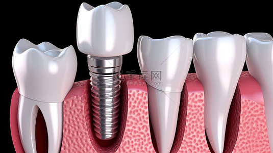 注入感情背景图片_牙种植体治疗过程的医学精确 3D 插图