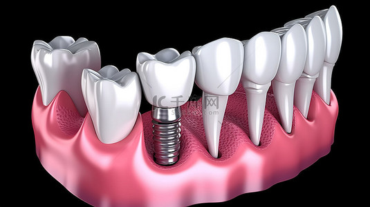 种植牙过程的准确 3D 插图