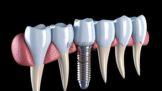 牙科种植过程的医学精确 3D 插图