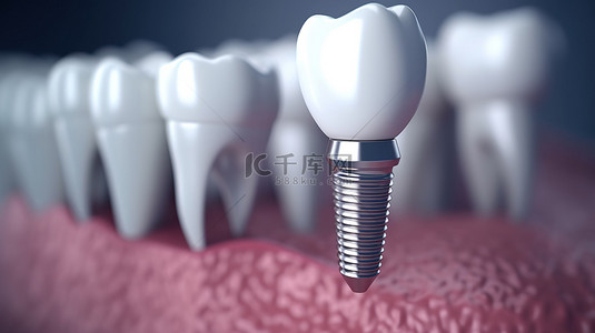 牙科医疗背景图片_用于医疗目的的牙种植体的 3D 渲染图像