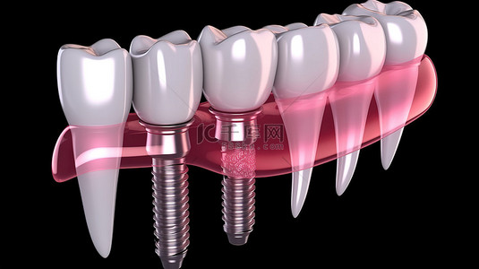 种植牙基台背景图片_牙种植过程医学上精确的义齿治疗 3D 渲染