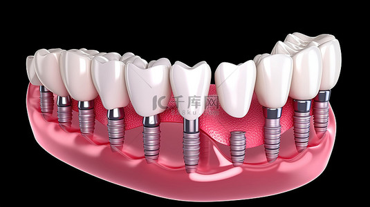 牙齿种植牙背景图片_牙科种植手术的医学精确 3D 插图