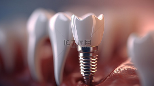 3D 渲染牙种植体治疗近距离选择性焦点