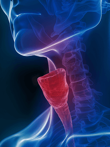 喉癌医疗照片
