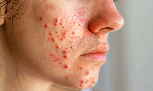蚊虫叮咬后皮肤过敏并出现皮疹