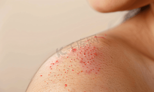 防蚊虫标识摄影照片_蚊虫叮咬后皮肤过敏并出现皮疹