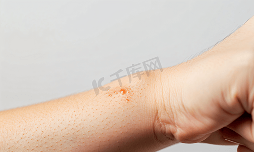 蚊虫叮咬后皮肤过敏并出现皮疹