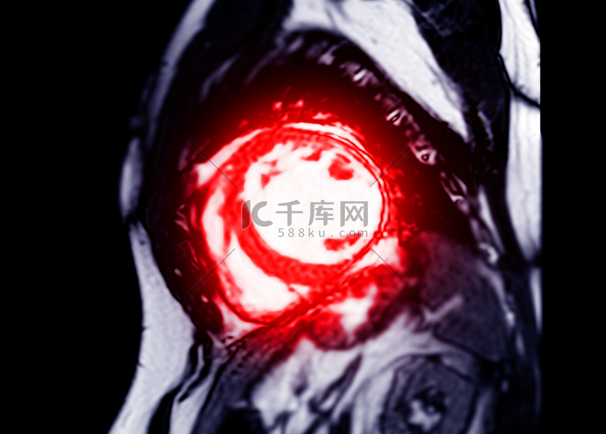 MRI 心脏或心脏 MRI 在短轴视图中显示用于诊断心脏病的左心室和右心室的横截面。高清摄影大图-千库网
