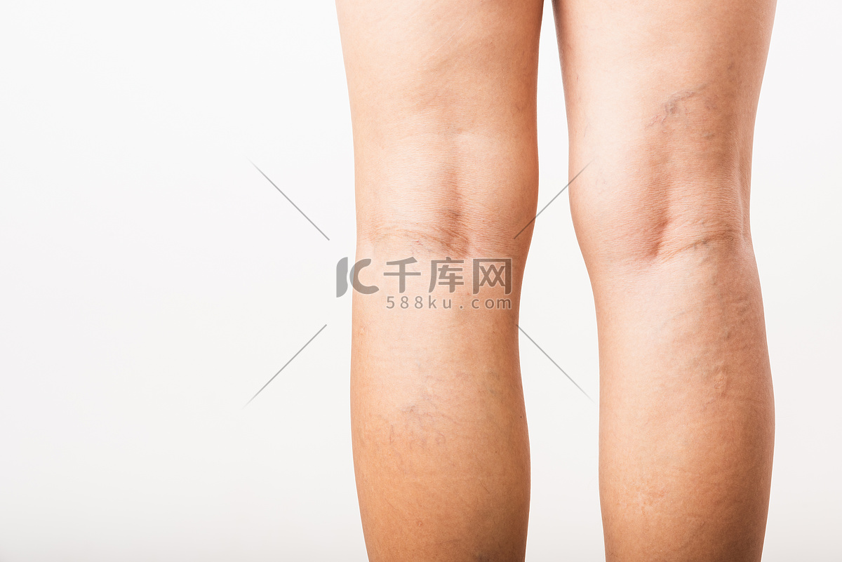 Varicose Veins: 6 Things You Need To Know | Sustain Health Magazine