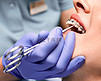 牙科医生用手把弹性橡皮筋贴在病人的支架上.牙齿上有金属丝支撑的妇女正在接受牙齿矫正治疗。口腔学、牙科学和正畸学的概念.
