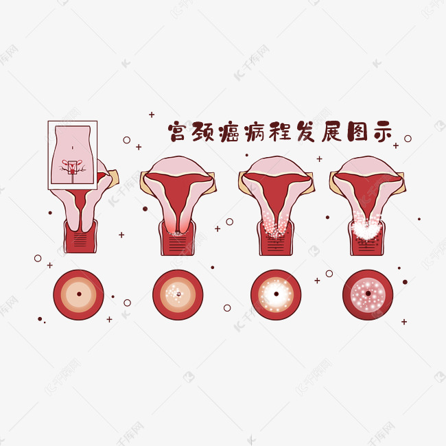 医疗人体组织器官宫颈癌