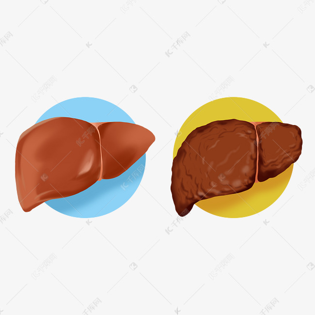 人体脏器肝硬化